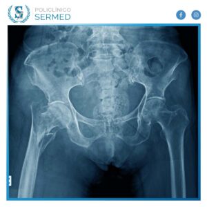 Los Tipos De Radiograf A De Rodilla Ap Lateral Y Oblicua Sermed