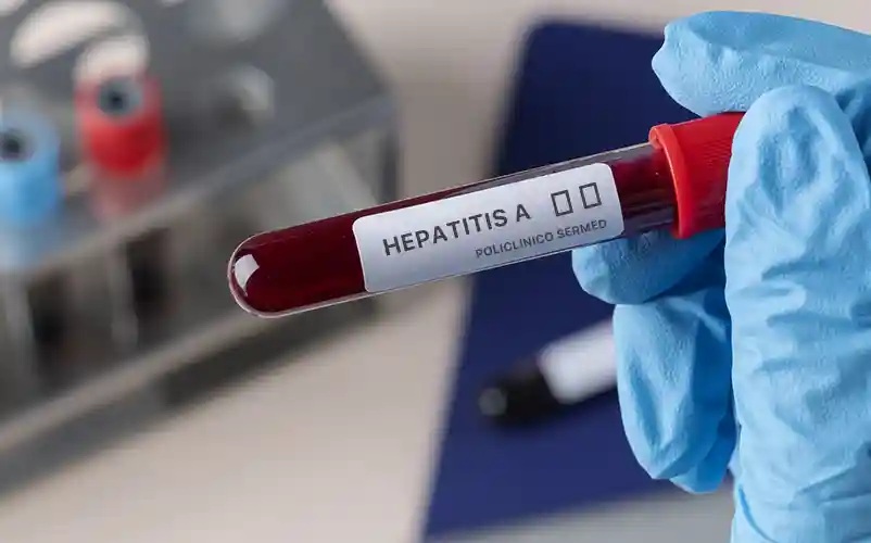 Hepatitis A