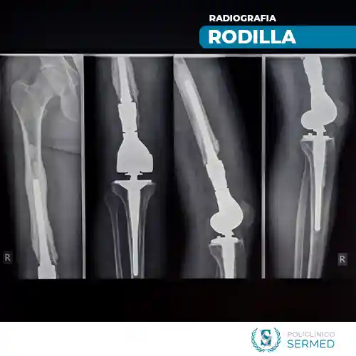 radiografia de rodilla