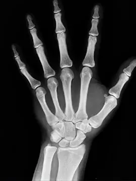 mano radiografica